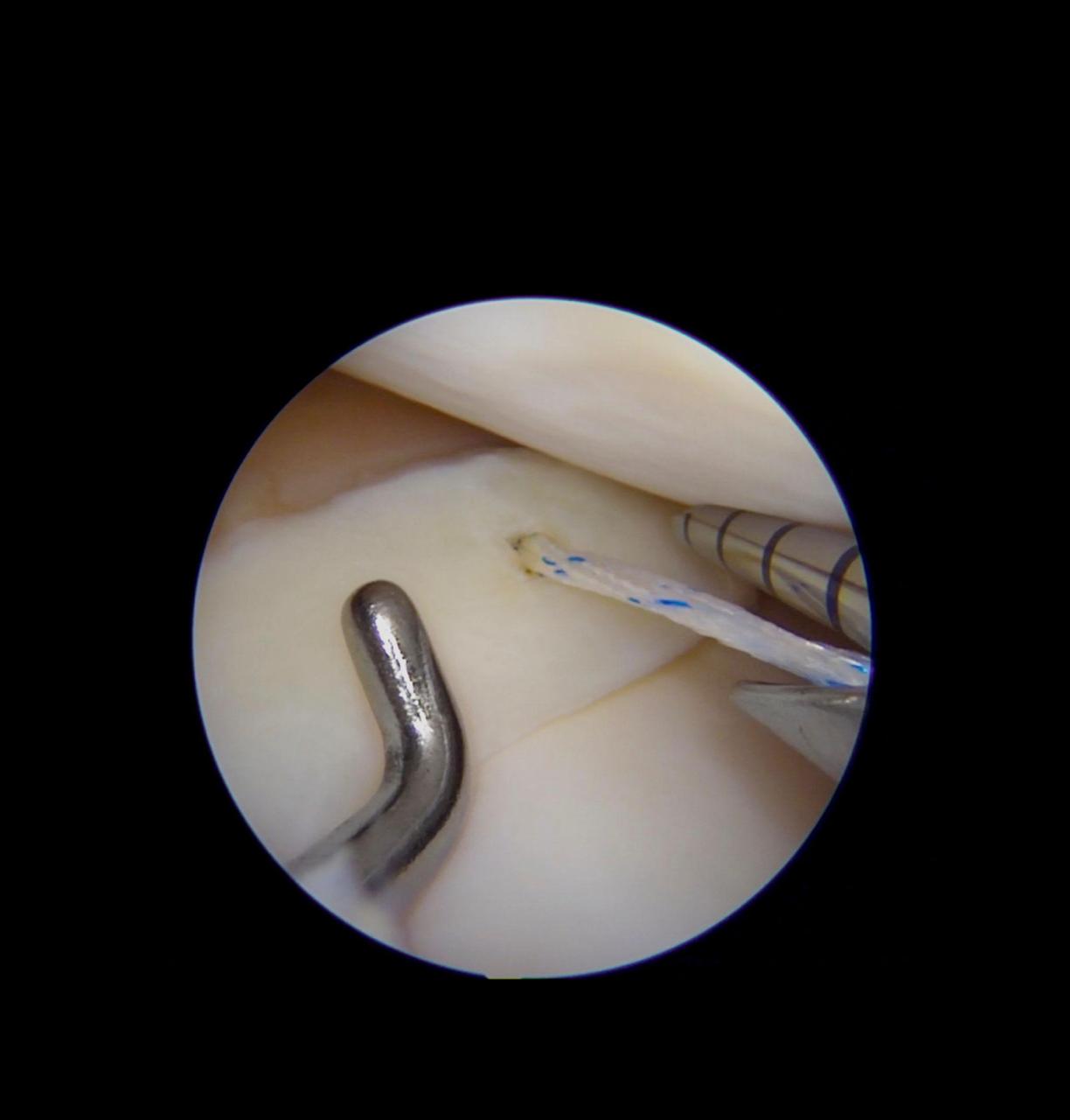 Meniscus surgery and knee arthroscopy in Bangalore